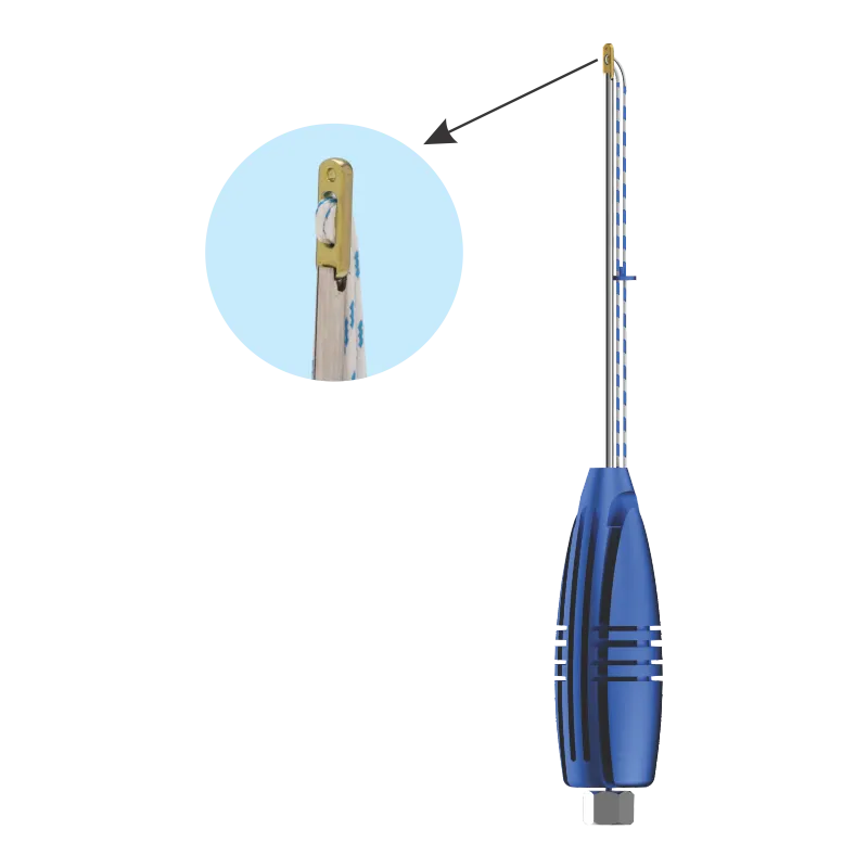 Implantes para artroscopia de tobillo