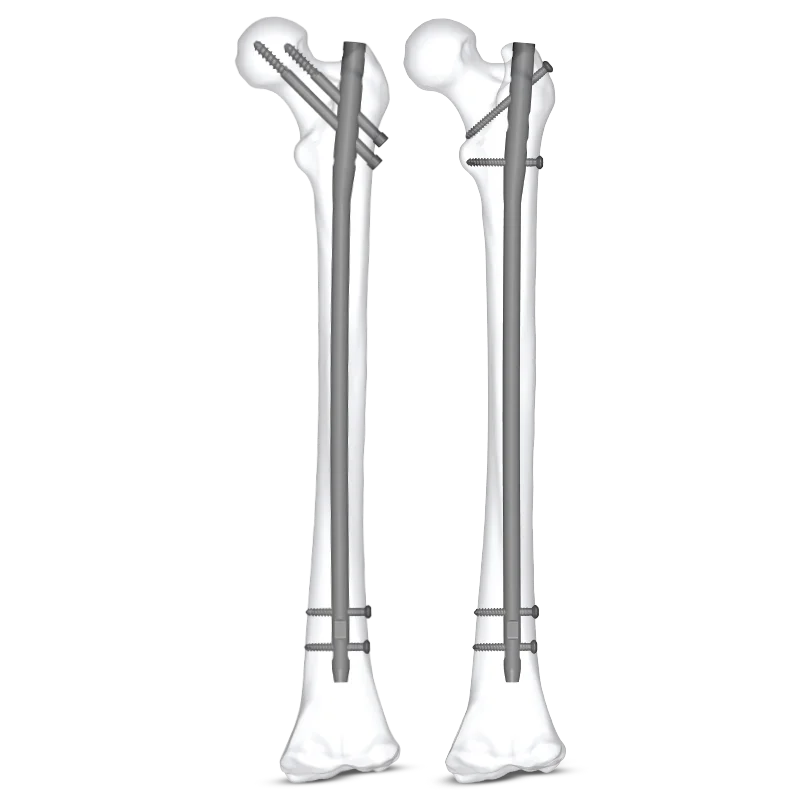 Clavo femoral Expert ADUERA